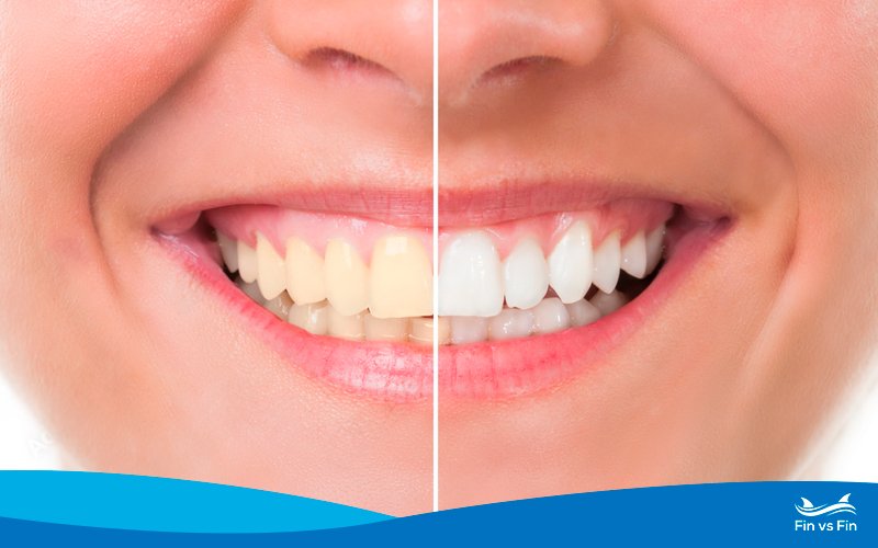 HiSmile vs Laughland vs Smile Direct Club: Best LED Teeth Whitening Kit Comparison