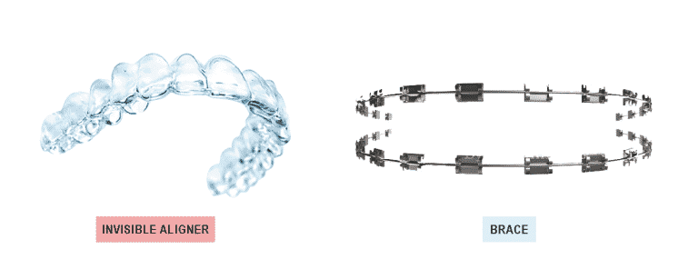 Aligner vs Braces