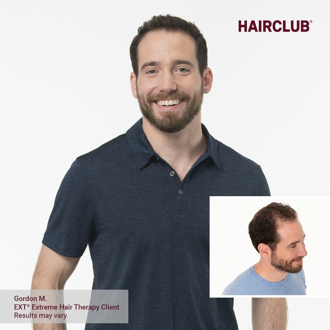 HairClub vs Bosley: What's The Best Hair Loss Clinic?