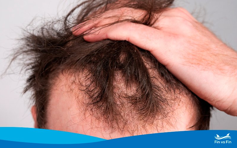 Finasteride vs Dutasteride: Which is Best for Hair Loss?