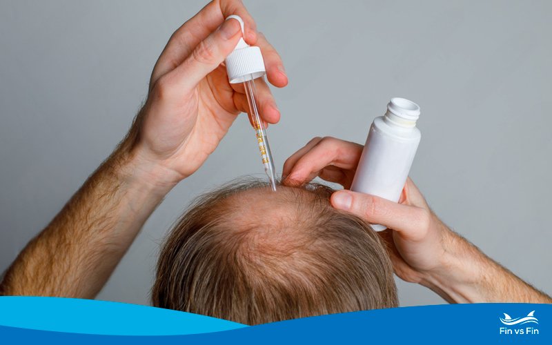 minoxidil topical treatment for hair loss