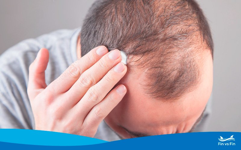 Tretinoin and Hair Loss: Does It Help Regrow Hair?