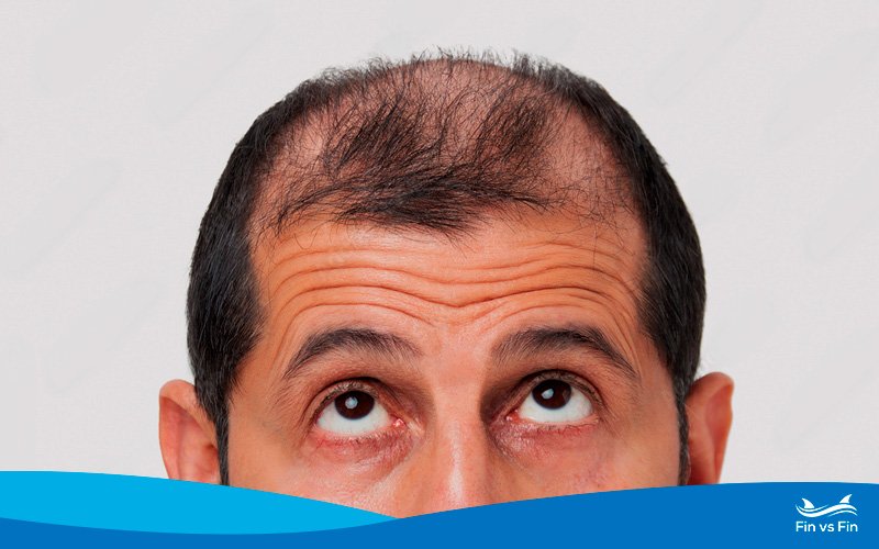 Navigating Hair Loss on TRT: Understanding, Prevention, and Management