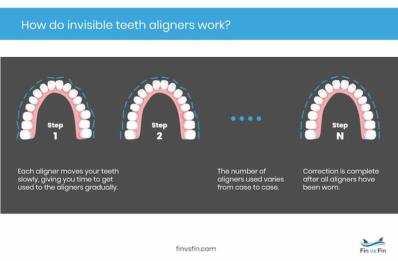how invisible aligners work