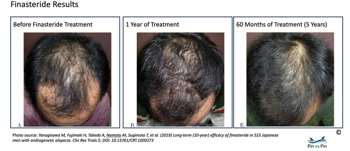 Propecia Hair Loss Reviews : Propecia Rogaine Before After Photos
